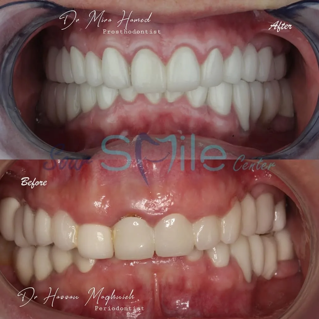 Before and after: bite correction and crowns
