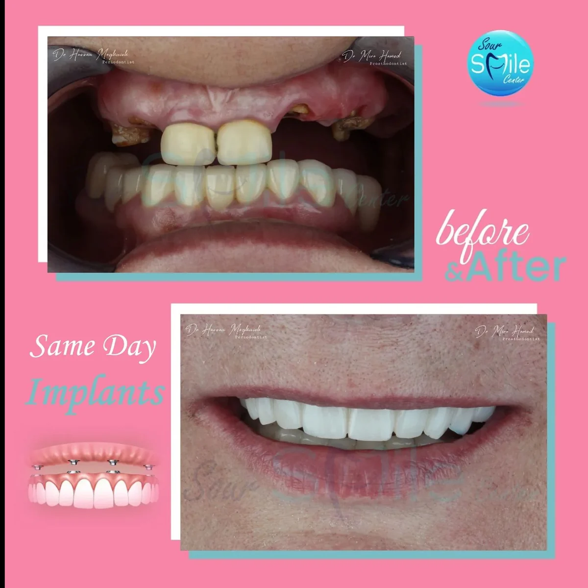 Same-day implants before and after