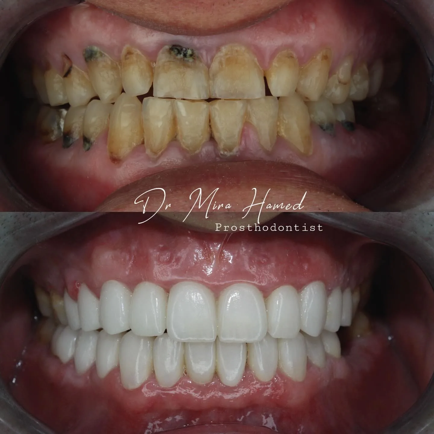 Before and after: crowns and veneers